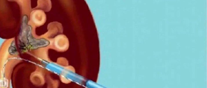 肾脏穿刺引流手术是什么？对运动员生涯是否有影响？